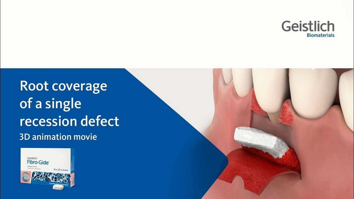 Recession Coverage with Geistlich Fibro-Gide®